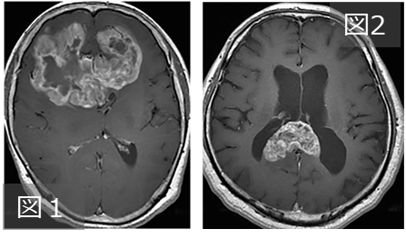 Butterfly glioblastoma̔N̉𖾁`]Ȃ̂H`--kw