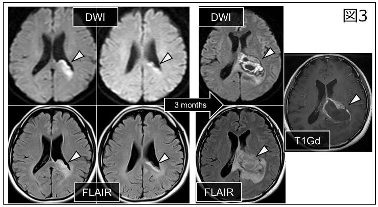 Butterfly glioblastoma̔N̉𖾁`]Ȃ̂H`--kw