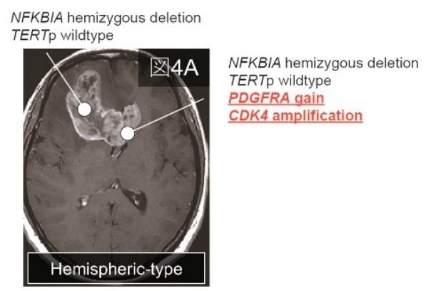 Butterfly glioblastoma̔N̉𖾁`]Ȃ̂H`--kw