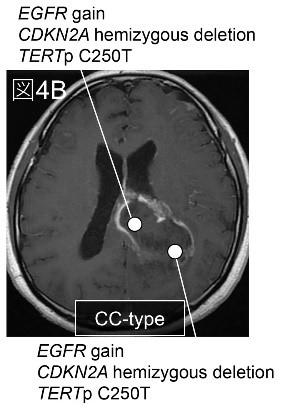 Butterfly glioblastoma̔N̉𖾁`]Ȃ̂H`--kw