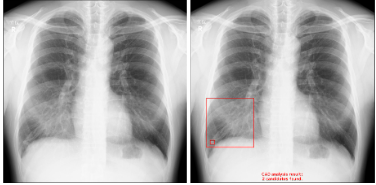 X摜̓ǉeffxEIRL Chest Screening̐Vf𔭔AoُAë̑Ώۏg