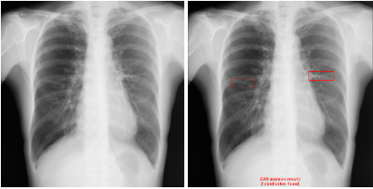 X摜̓ǉeffxEIRL Chest Screening̐Vf𔭔AoُAë̑Ώۏg