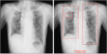 X摜̓ǉeffxEIRL Chest Screening̐Vf𔭔AoُAë̑Ώۏg