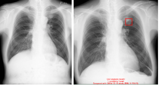 X摜̓ǉeffxEIRL Chest Screening̐Vf𔭔Aߋoʔr@\ǉArǉex\